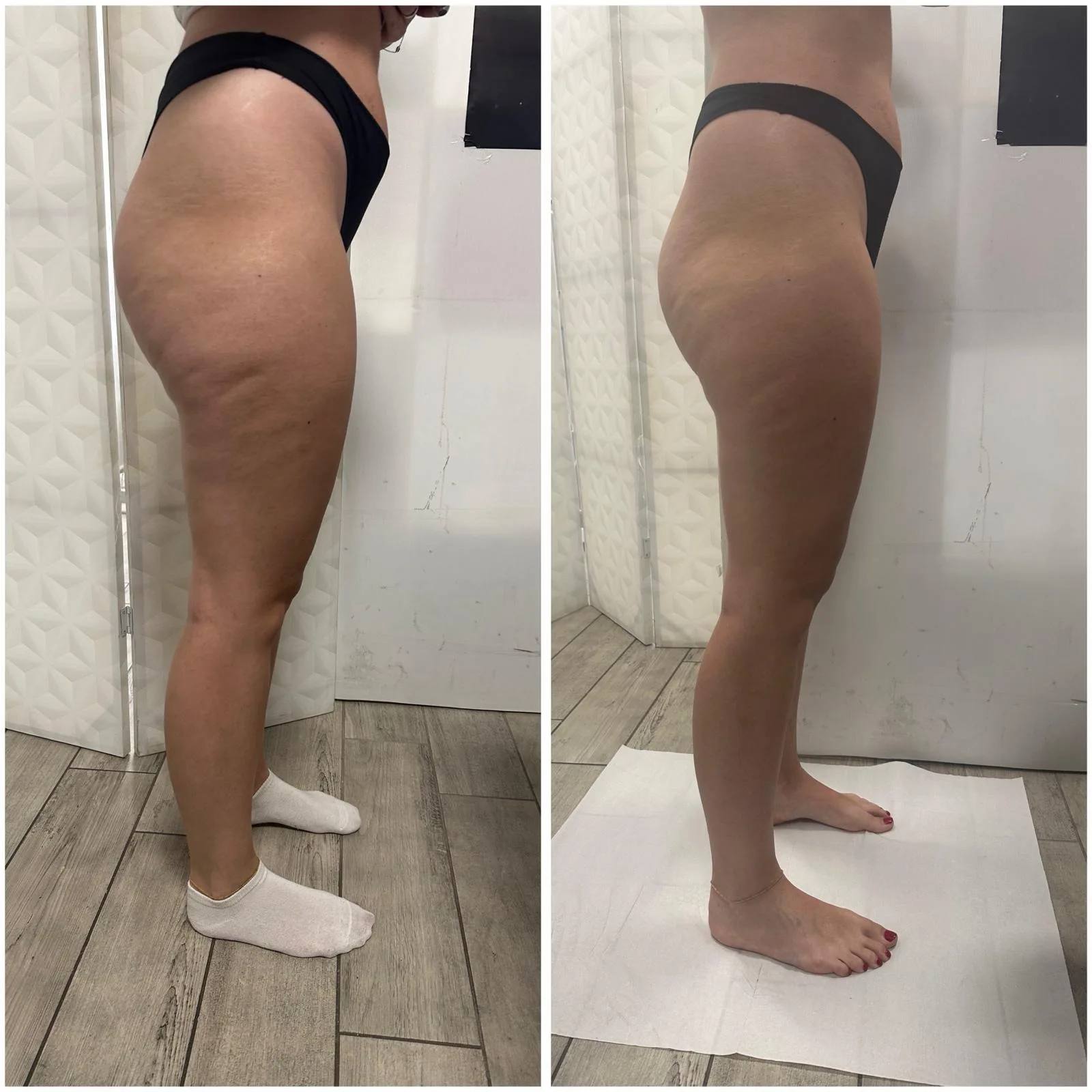 Trattamento drenante: confronto gambe